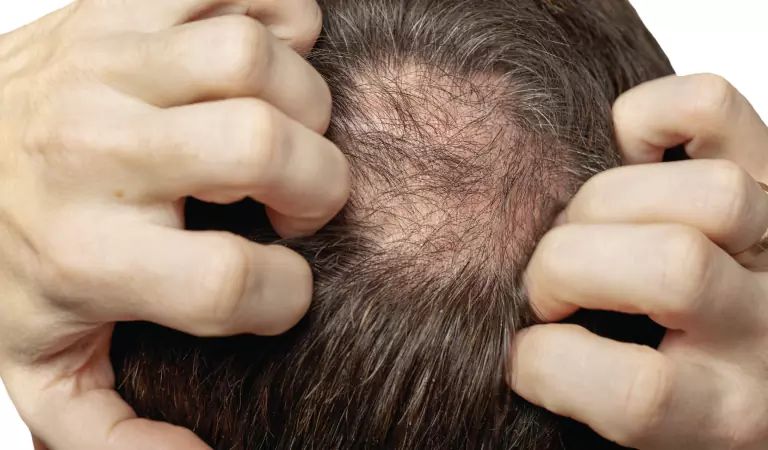 male pattern baldness