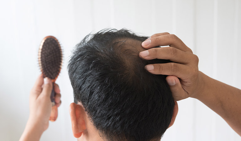 male pattern baldness