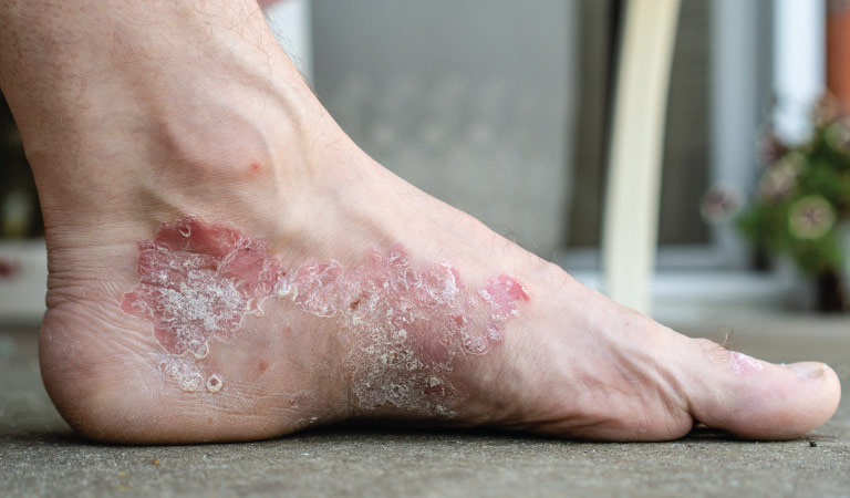 psoriasis