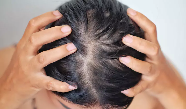 female pattern baldness