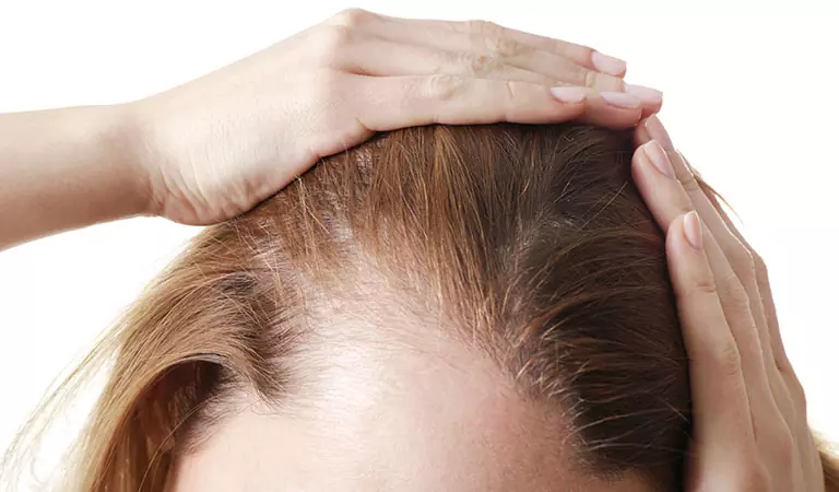 female pattern baldness