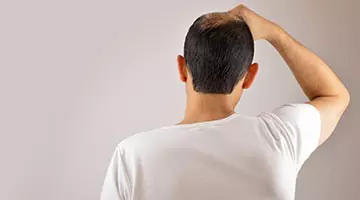 male pattern baldness