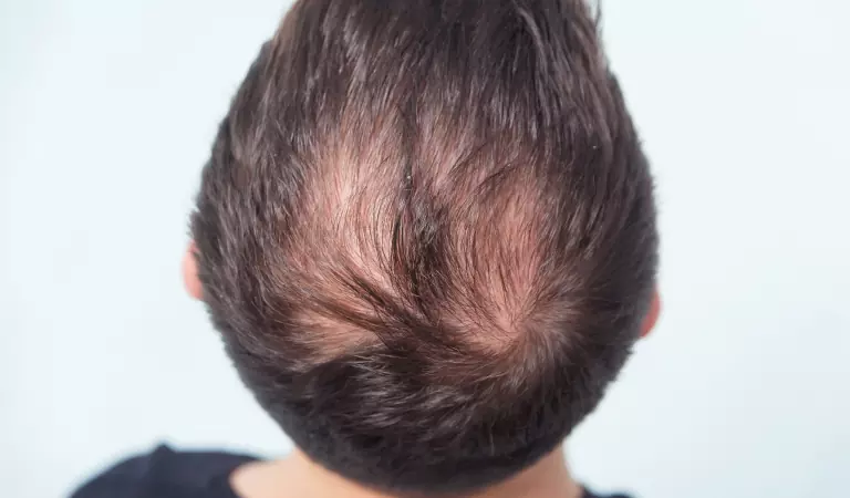 male pattern baldness