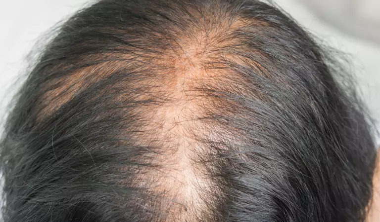 female pattern baldness