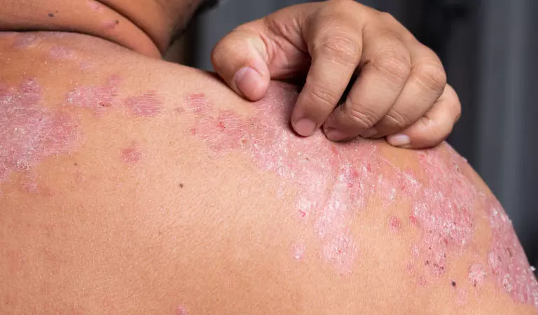 psoriasis