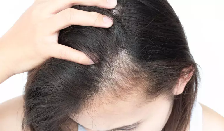 female pattern baldness