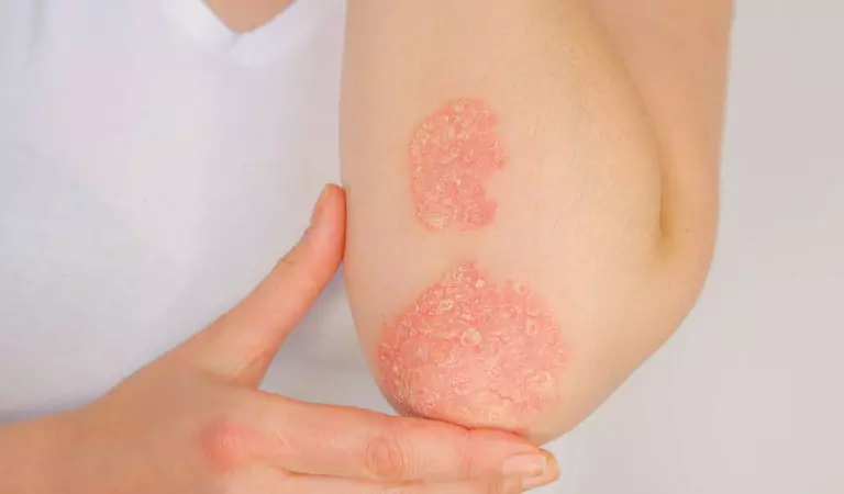 psoriasis