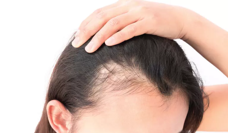 female pattern baldness