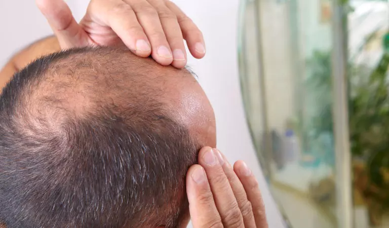 male pattern baldness