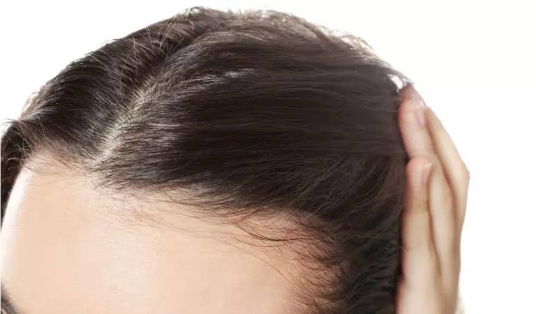 female pattern baldness