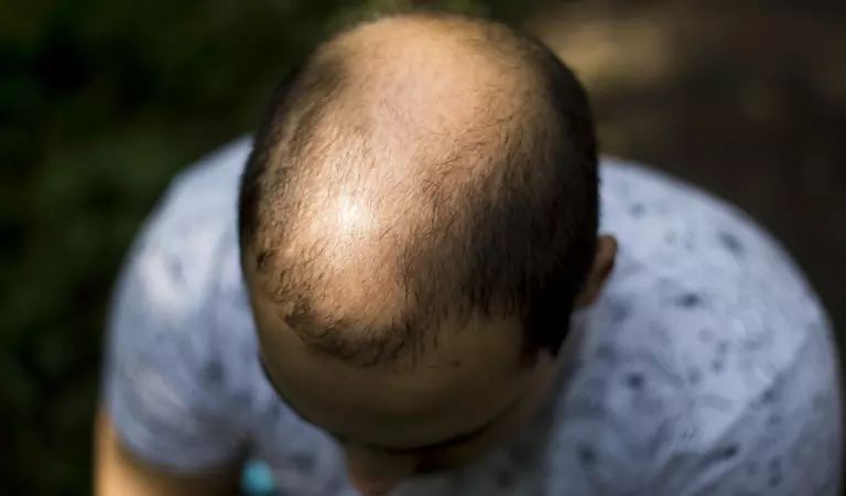 male pattern baldness