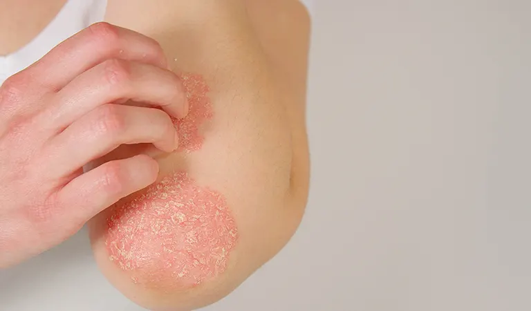 psoriasis