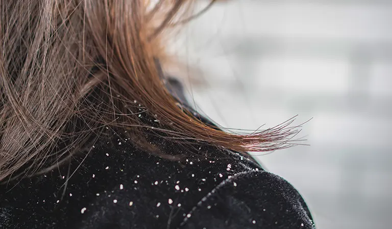 dandruff