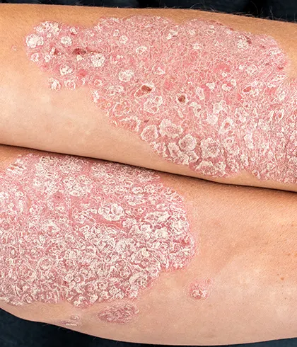 psoriasis