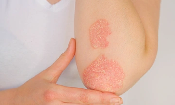 psoriasis