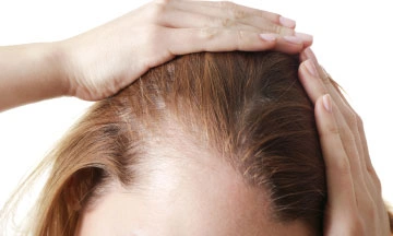 female pattern baldness