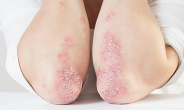 psoriasis