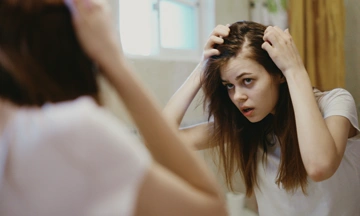 female pattern baldness