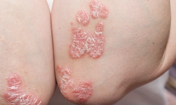 psoriasis