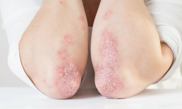 psoriasis