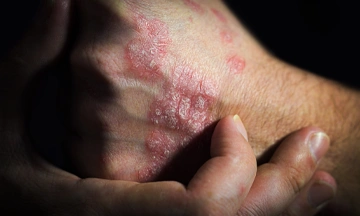 psoriasis