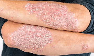 psoriasis