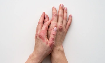 psoriasis