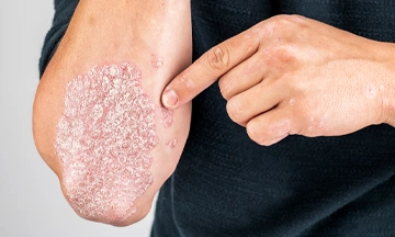 psoriasis