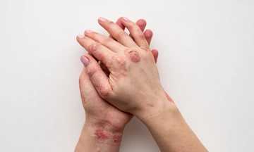 psoriasis