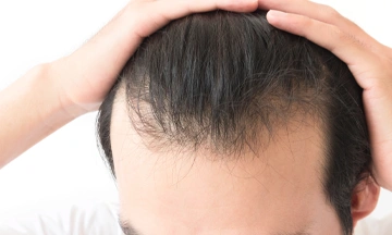 male pattern baldness