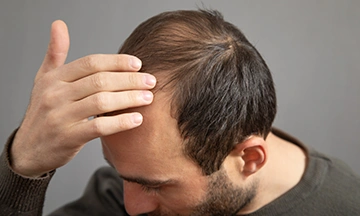 male pattern baldness