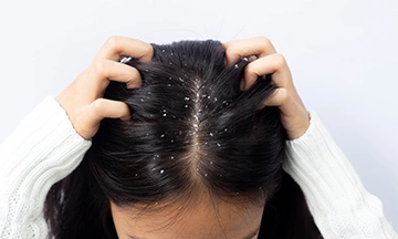 dandruff