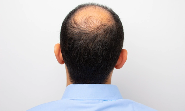 male pattern baldness