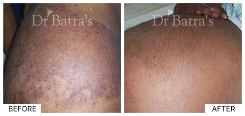 skin treatment case 3
