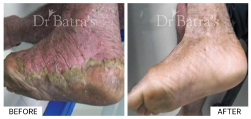 skin treatment case 4