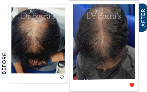 cider-vinegar-for-hair-fall-before-after-1.webp