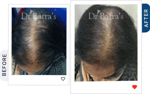 cider-vinegar-for-hair-fall-before-after-2.webp