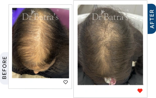 cider-vinegar-for-hair-fall-before-after-3.webp