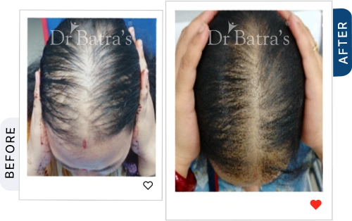 cider-vinegar-for-hair-fall-before-after-4.webp