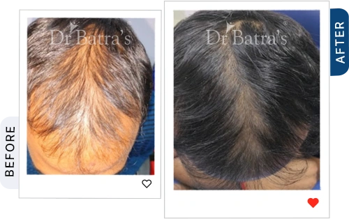 cider-vinegar-for-hair-fall-before-after51.webp