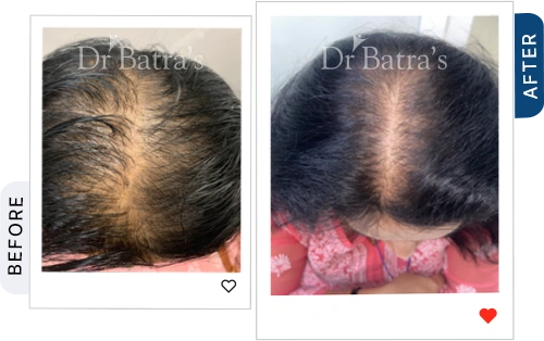 hair-loss-it-may-be-anaemia-iron-deficiency-before-after-1.webp