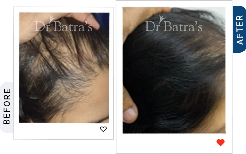 hair-loss-it-may-be-anaemia-iron-deficiency-before-after-2.webp