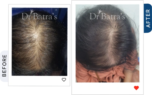 hair-loss-it-may-be-anaemia-iron-deficiency-before-after-3.webp