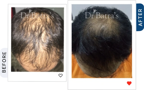 hair-loss-it-may-be-anaemia-iron-deficiency-before-after-4.webp