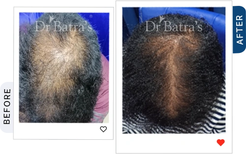 hair-loss-it-may-be-anaemia-iron-deficiency-before-after-5.webp