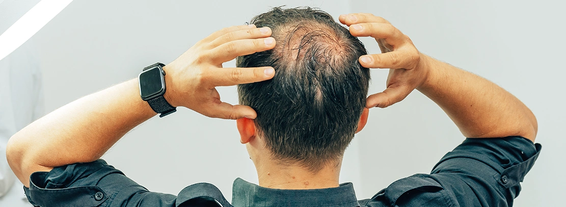 male pattern baldness