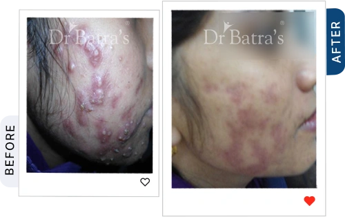 rosacea not acne before after 1