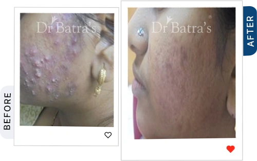 rosacea not acne before after 2