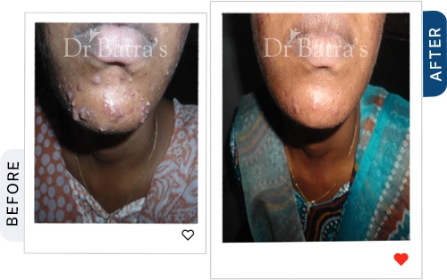 rosacea not acne before after 3