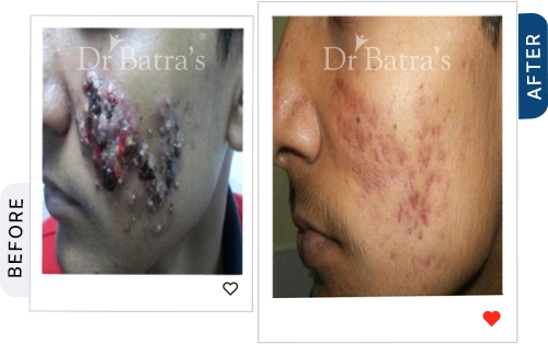 rosacea not acne before after 4